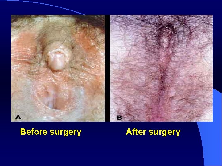 Before surgery After surgery 