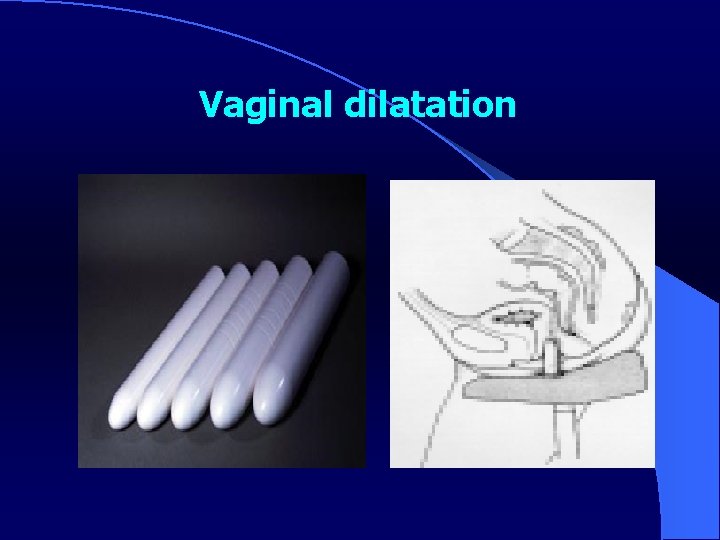 Vaginal dilatation 