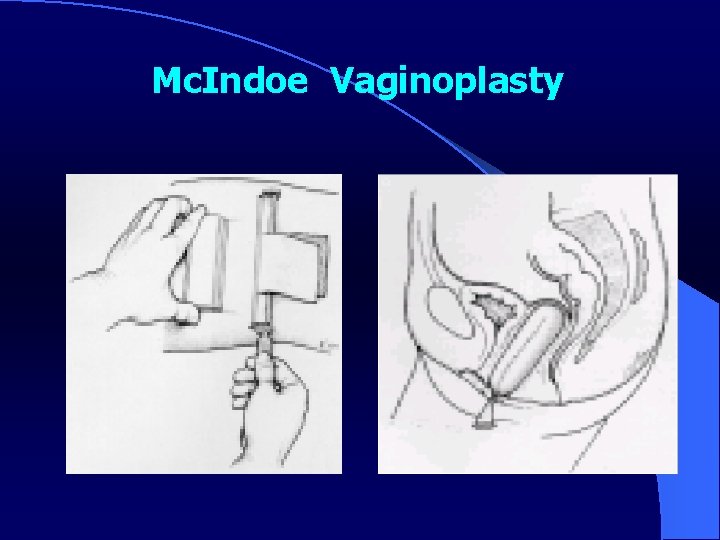 Mc. Indoe Vaginoplasty 