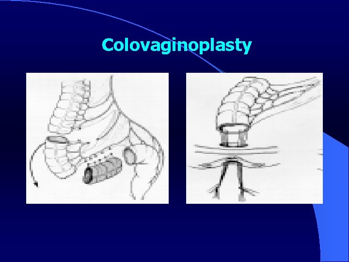 Colovaginoplasty 