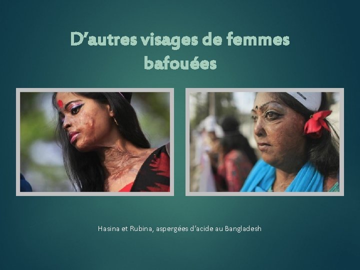 D’autres visages de femmes bafouées Hasina et Rubina, aspergées d’acide au Bangladesh 