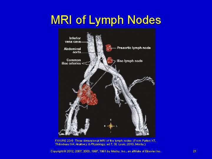MRI of Lymph Nodes FIGURE 23 -6 Three dimensional MRI of the lymph nodes.