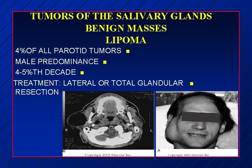 TUMORS OF THE SALIVARY GLANDS BENIGN MASSES LIPOMA 4%OF ALL PAROTID TUMORS n MALE