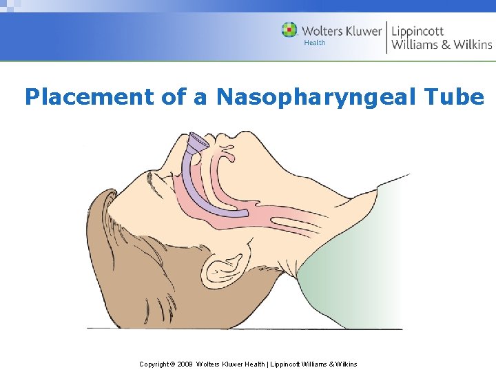 Placement of a Nasopharyngeal Tube Copyright © 2009 Wolters Kluwer Health | Lippincott Williams