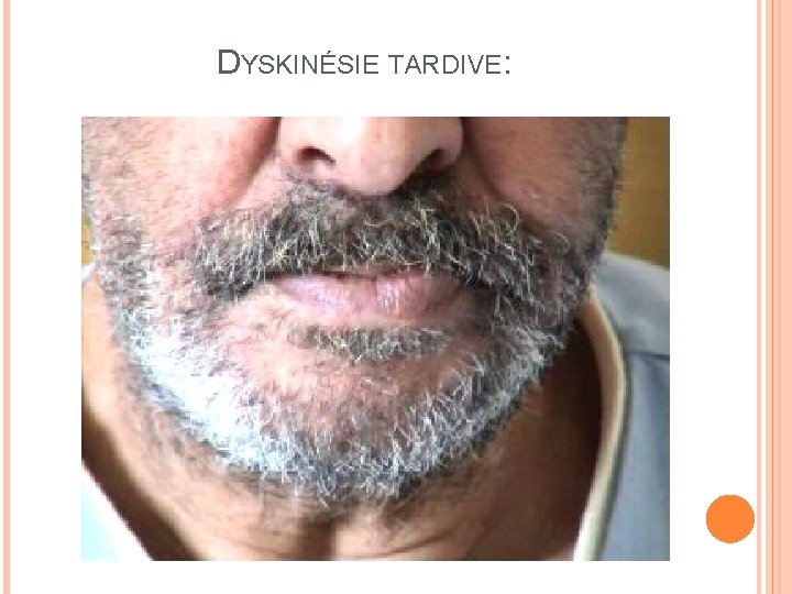 DYSKINÉSIE TARDIVE: 