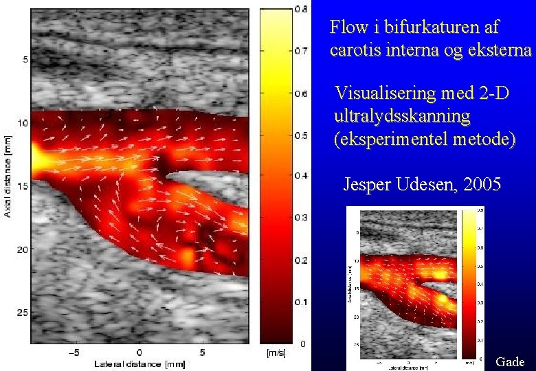 Flow i bifurkaturen af carotis interna og eksterna Visualisering med 2 -D ultralydsskanning (eksperimentel