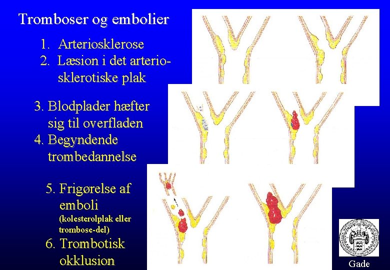 Tromboser og embolier 1. Arteriosklerose 2. Læsion i det arteriosklerotiske plak 3. Blodplader hæfter