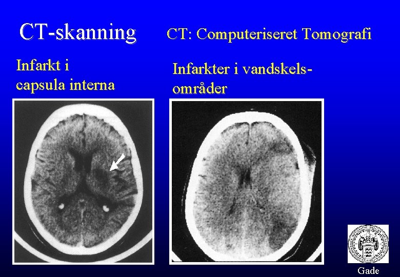 CT-skanning Infarkt i capsula interna CT: Computeriseret Tomografi Infarkter i vandskelsområder Gade 