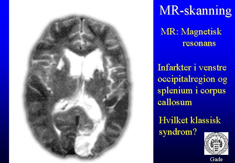 MR-skanning MR: Magnetisk resonans Infarkter i venstre occipitalregion og splenium i corpus callosum Hvilket