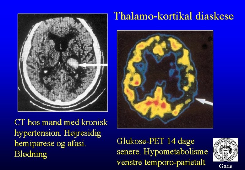 Thalamo-kortikal diaskese CT hos mand med kronisk hypertension. Højresidig hemiparese og afasi. Blødning Glukose-PET