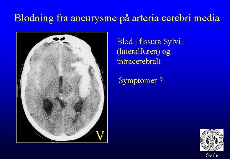 Blødning fra aneurysme på arteria cerebri media Blod i fissura Sylvii (lateralfuren) og intracerebralt