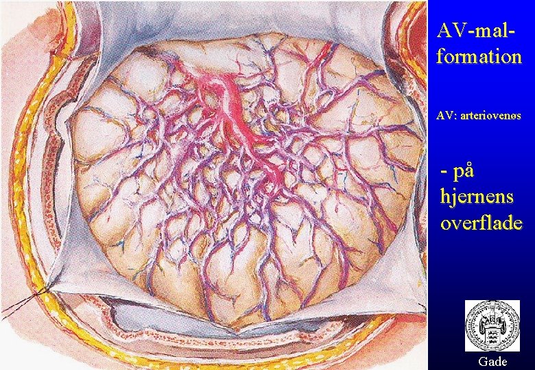 AV-malformation AV: arteriovenøs - på hjernens overflade Gade 