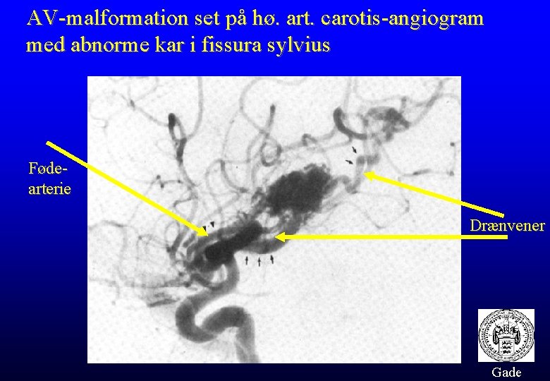 AV-malformation set på hø. art. carotis-angiogram med abnorme kar i fissura sylvius Fødearterie Drænvener