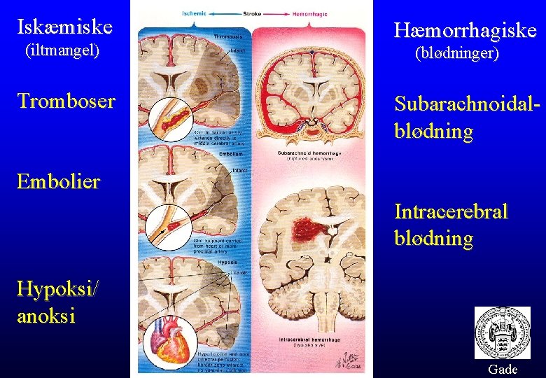 Iskæmiske (iltmangel) Tromboser Hæmorrhagiske (blødninger) Subarachnoidalblødning Embolier Intracerebral blødning Hypoksi/ anoksi Gade 