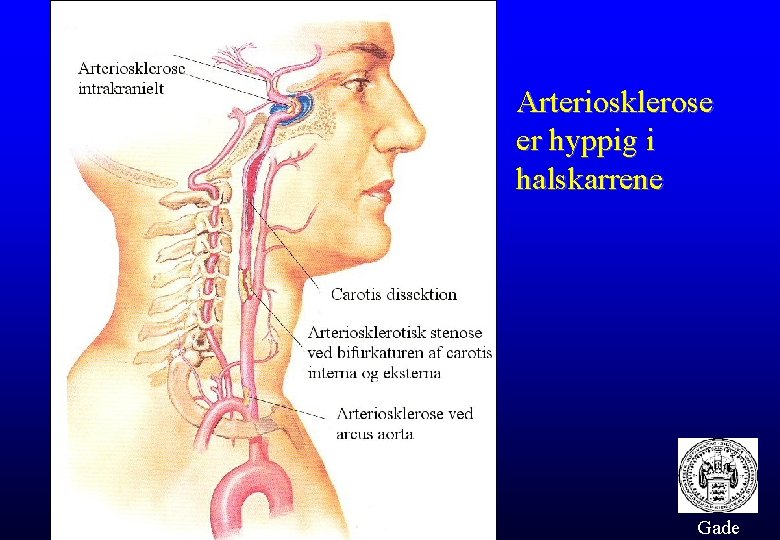 Arteriosklerose er hyppig i halskarrene Gade 