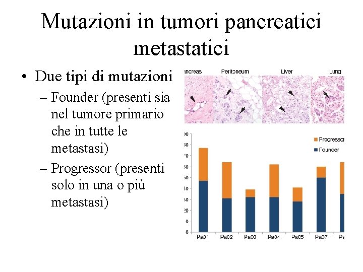 Mutazioni in tumori pancreatici metastatici • Due tipi di mutazioni – Founder (presenti sia