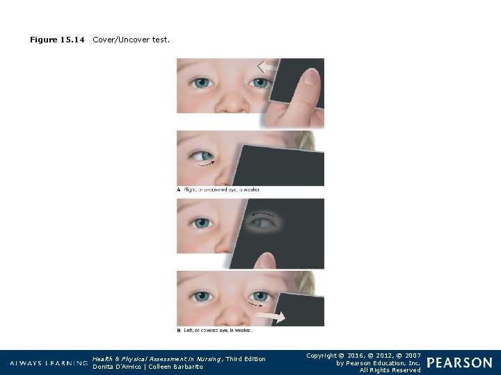 Figure 15. 14 Cover/Uncover test. Health & Physical Assessment in Nursing, Third Edition Donita