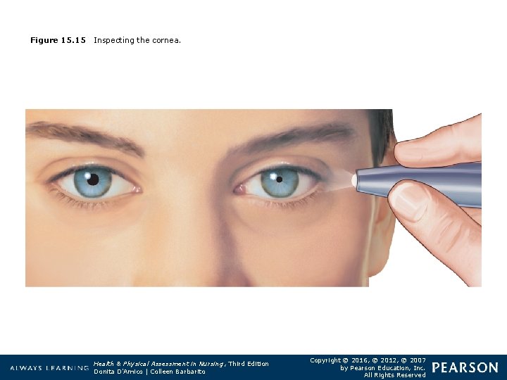 Figure 15. 15 Inspecting the cornea. Health & Physical Assessment in Nursing, Third Edition