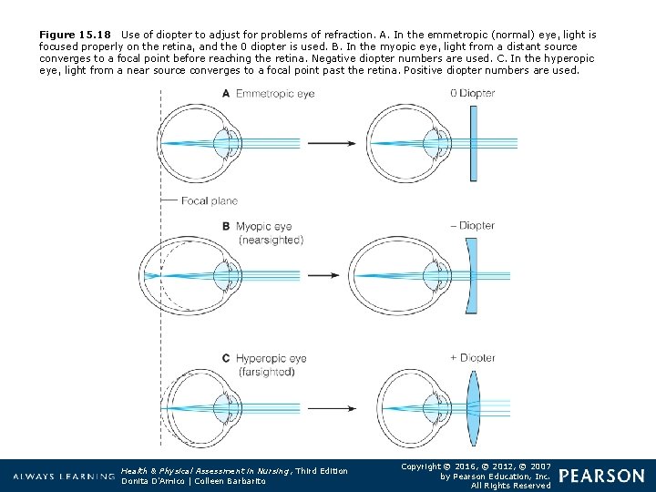 Figure 15. 18 Use of diopter to adjust for problems of refraction. A. In