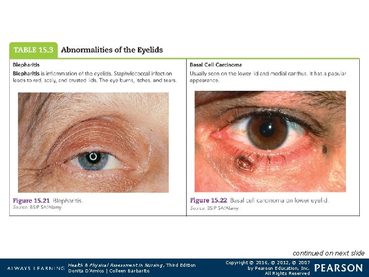 Table 15. 3 Abnormalities of the Eyelids continued on next slide Health & Physical