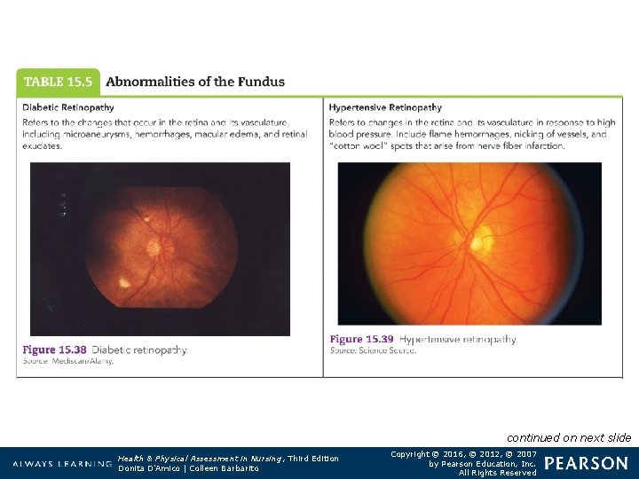 Table 15. 5 Abnormalities of the Fundus continued on next slide Health & Physical