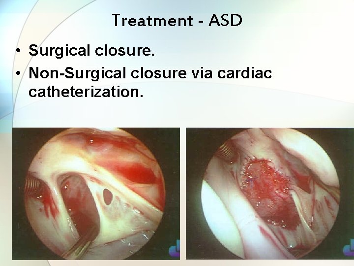 Treatment - ASD • Surgical closure. • Non-Surgical closure via cardiac catheterization. 