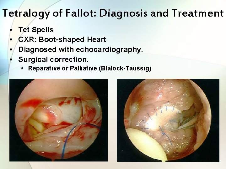 Tetralogy of Fallot: Diagnosis and Treatment • • Tet Spells CXR: Boot-shaped Heart Diagnosed