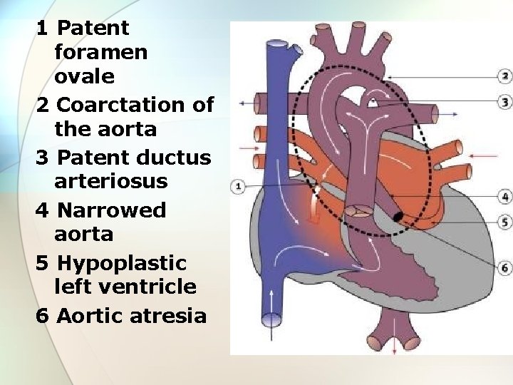 1 Patent foramen ovale 2 Coarctation of the aorta 3 Patent ductus arteriosus 4