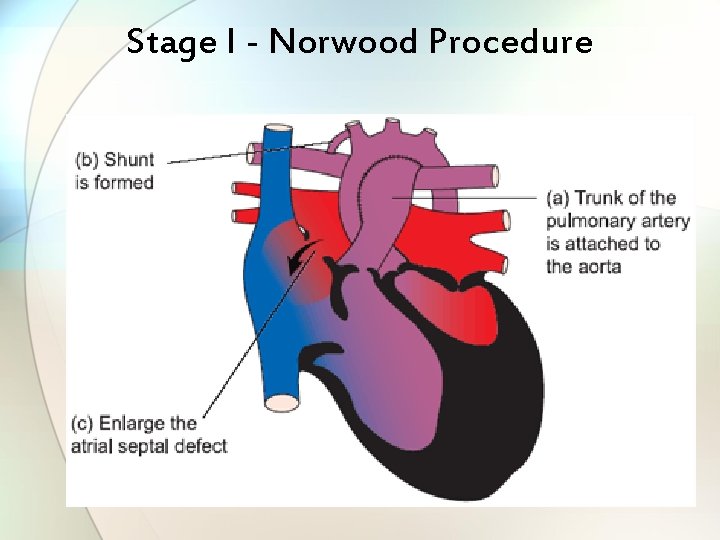 Stage I - Norwood Procedure 