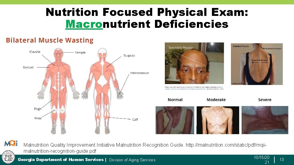 Nutrition Focused Physical Exam: Macronutrient Deficiencies Malnutrition Quality Improvement Initiative Malnutrition Recognition Guide. http: