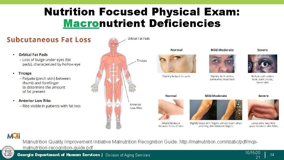 Nutrition Focused Physical Exam: Macronutrient Deficiencies Malnutrition Quality Improvement Initiative Malnutrition Recognition Guide. http: