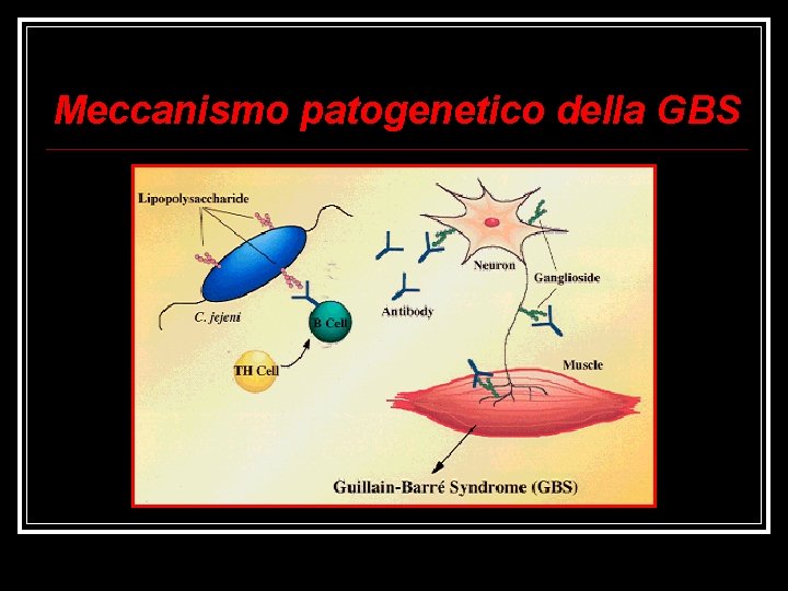 Meccanismo patogenetico della GBS 