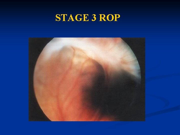 STAGE 3 ROP 