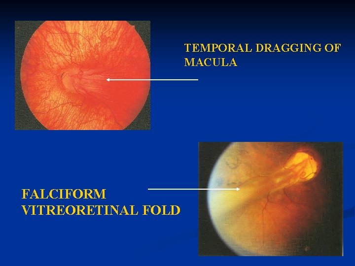 TEMPORAL DRAGGING OF MACULA FALCIFORM VITREORETINAL FOLD 