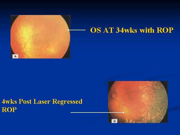 OS AT 34 wks with ROP 4 wks Post Laser Regressed ROP 