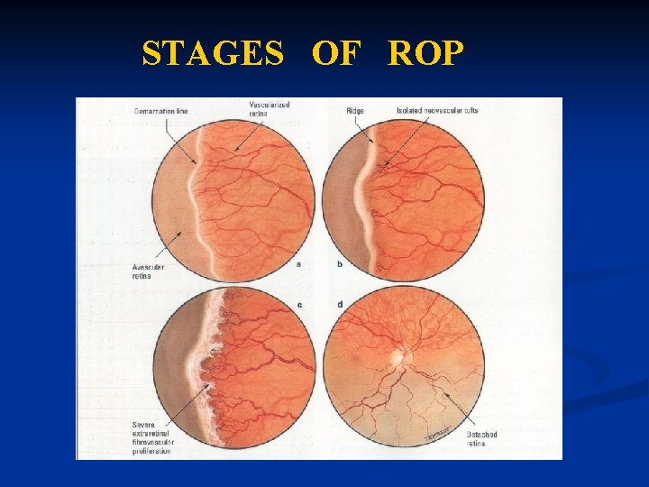 STAGES OF ROP 