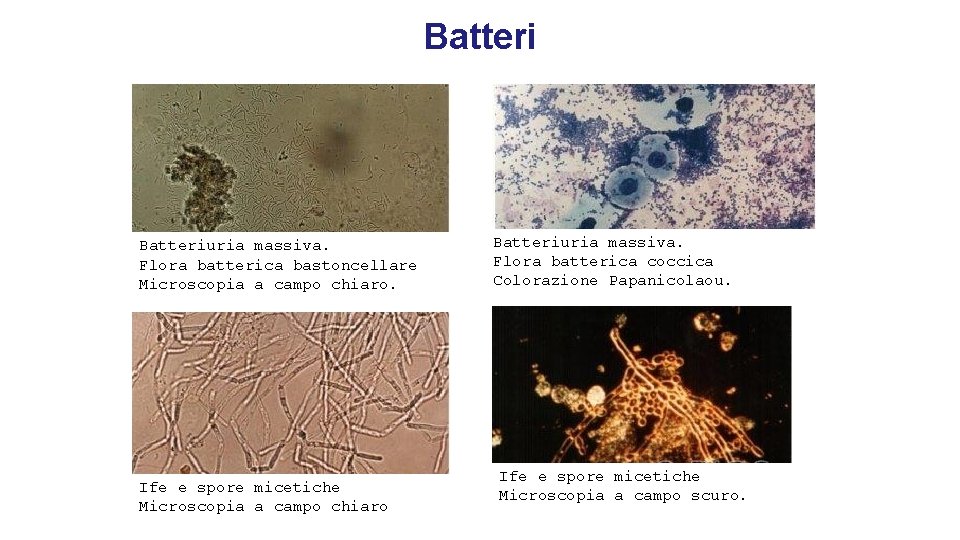 Batteriuria massiva. Flora batterica bastoncellare Microscopia a campo chiaro. Ife e spore micetiche Microscopia