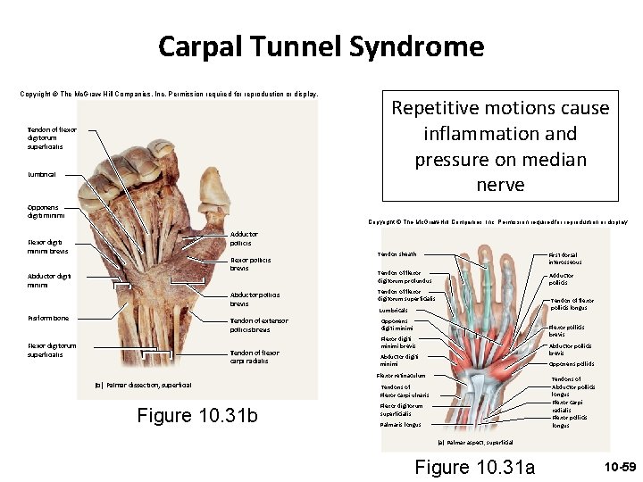 Carpal Tunnel Syndrome Copyright © The Mc. Graw-Hill Companies, Inc. Permission required for reproduction