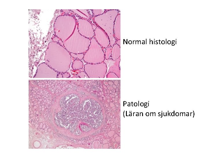 Normal histologi Patologi (Läran om sjukdomar) 
