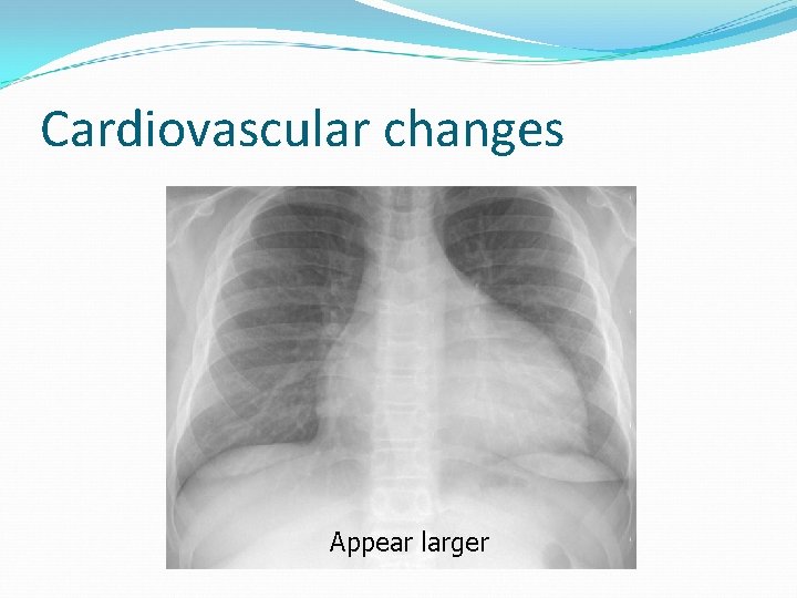 Cardiovascular changes Appear larger 