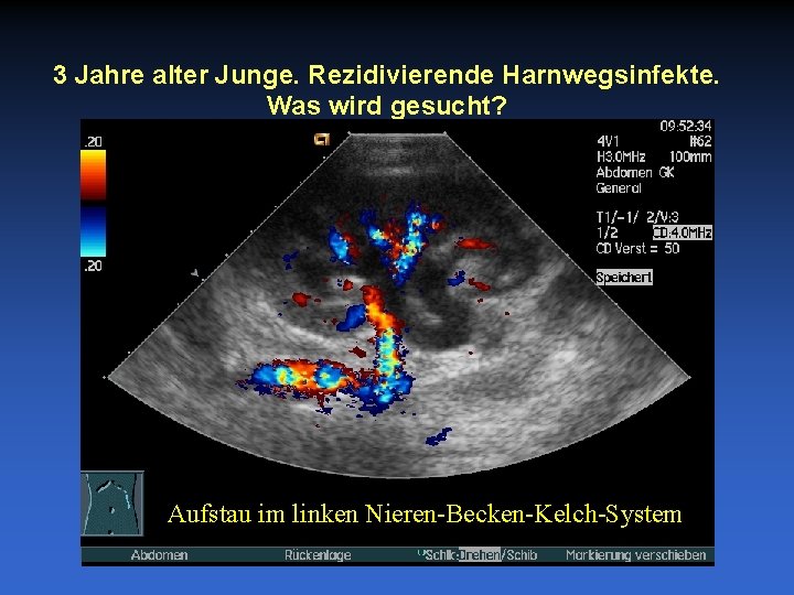 3 Jahre alter Junge. Rezidivierende Harnwegsinfekte. Was wird gesucht? Aufstau im linken Nieren-Becken-Kelch-System 