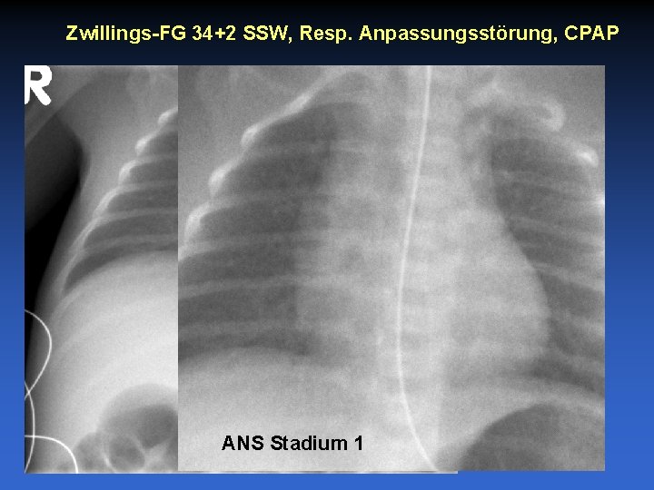 Zwillings-FG 34+2 SSW, Resp. Anpassungsstörung, CPAP ANS Stadium 1 