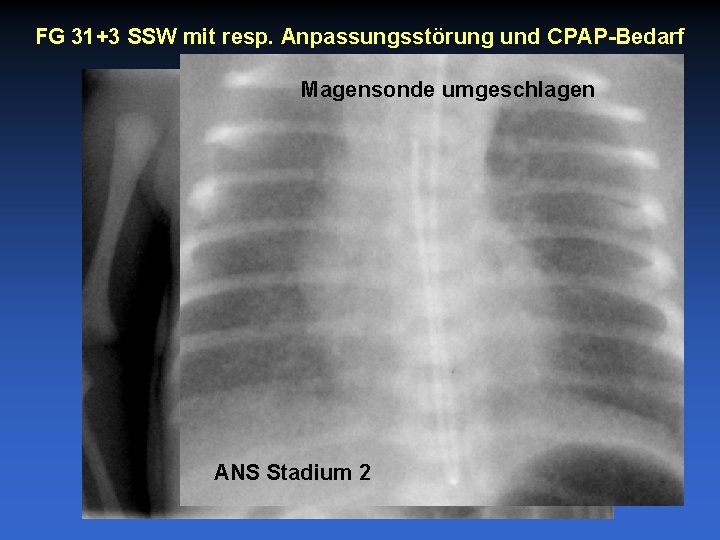 FG 31+3 SSW mit resp. Anpassungsstörung und CPAP-Bedarf Magensonde umgeschlagen ANS Stadium 2 