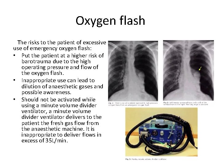 Oxygen flash The risks to the patient of excessive use of emergency oxygen flash: