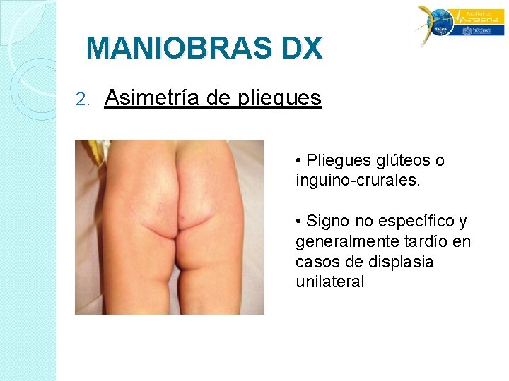 MANIOBRAS DX 2. Asimetría de pliegues • Pliegues glúteos o inguino-crurales. • Signo no MANIOBRAS DX 2. Asimetría de pliegues • Pliegues glúteos o inguino-crurales. • Signo no