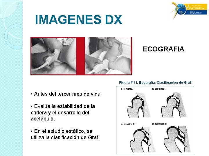 IMAGENES DX ECOGRAFIA • Antes del tercer mes de vida • Evalúa la estabilidad IMAGENES DX ECOGRAFIA • Antes del tercer mes de vida • Evalúa la estabilidad