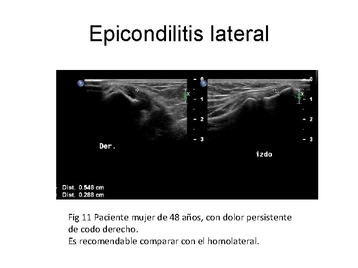 Epicondilitis lateral Fig 11 Paciente mujer de 48 años, con dolor persistente de codo