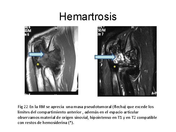 Hemartrosis * * Fig 22 En la RM se aprecia una masa pseudotumoral (flecha)