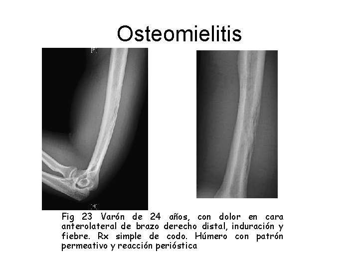Osteomielitis Fig 23 Varón de 24 años, con dolor en cara anterolateral de brazo