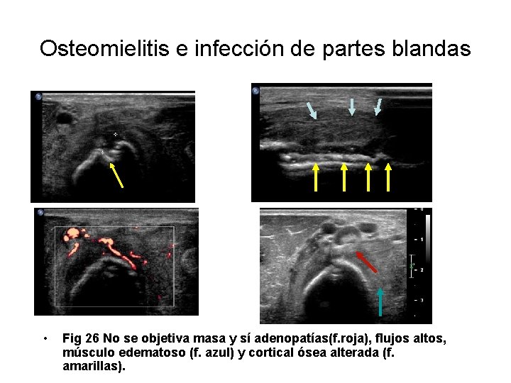 Osteomielitis e infección de partes blandas • Fig 26 No se objetiva masa y